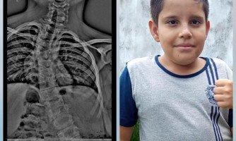 Regionalmente, Amigos e Familiares se Unem em Solidariedade para Realizar Cirurgia Vital para Adolescente de 12 Anos; Iniciativas Visam Arrecadar Cerca de 300 Mil Reais Necessários Para a Cirurgia