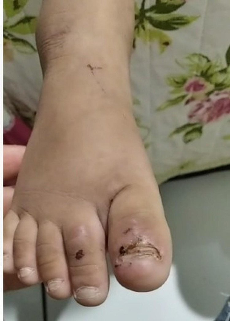 Padrasto suspeito de torturar menina de 6 anos com deficiência visual é procurado pela polícia em MT