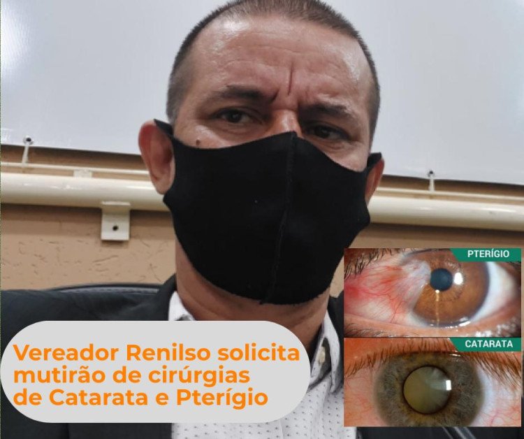 CIRURGIAS DE CATARATA E PTERÍGIO: vereador Renilson solicita mutirão para atendimentos