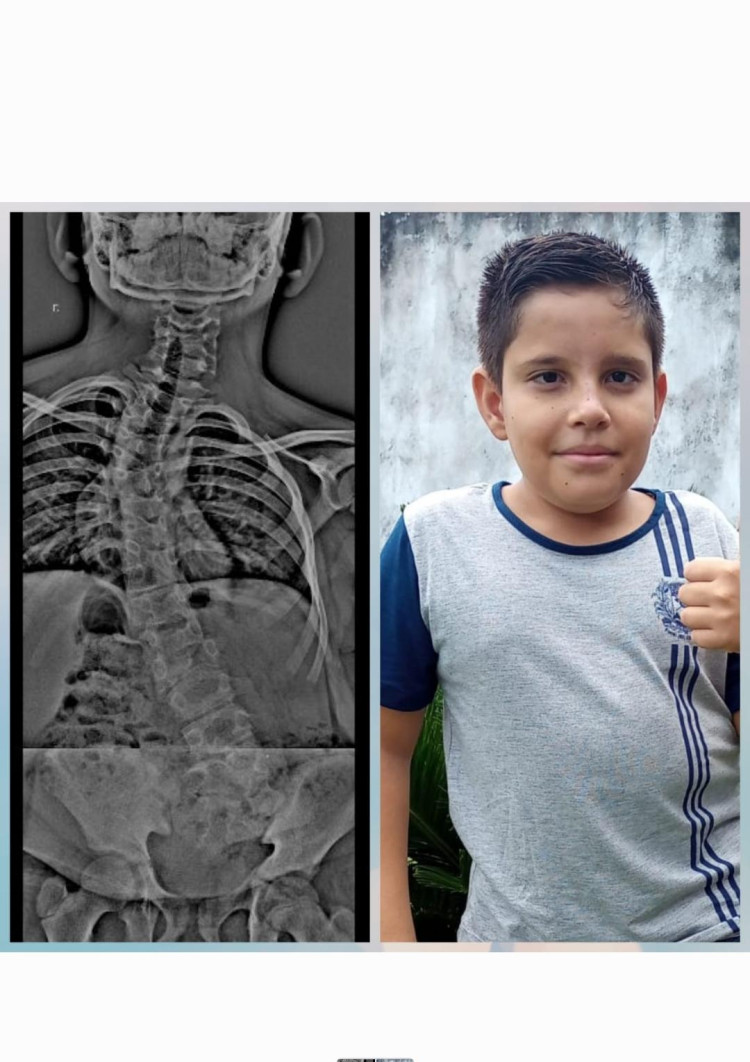 Regionalmente, Amigos e Familiares se Unem em Solidariedade para Realizar Cirurgia Vital para Adolescente de 12 Anos; Iniciativas Visam Arrecadar Cerca de 300 Mil Reais Necessários Para a Cirurgia