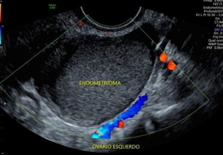 SUS vai ofertar novos tratamentos para endometriose